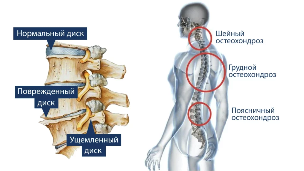Виды и стадии остеохондроза