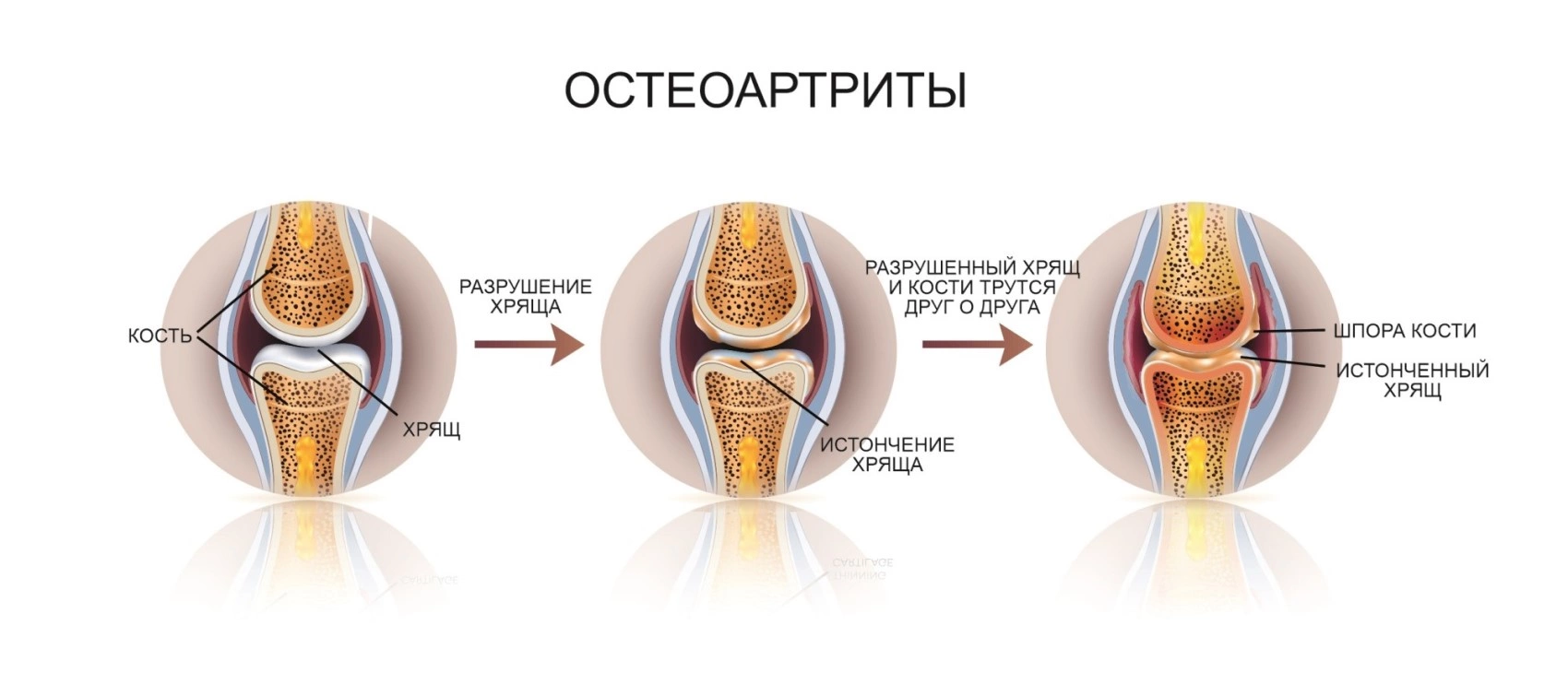Заботьтесь о своих суставах: Сигналы болезни, причины и методы лечения